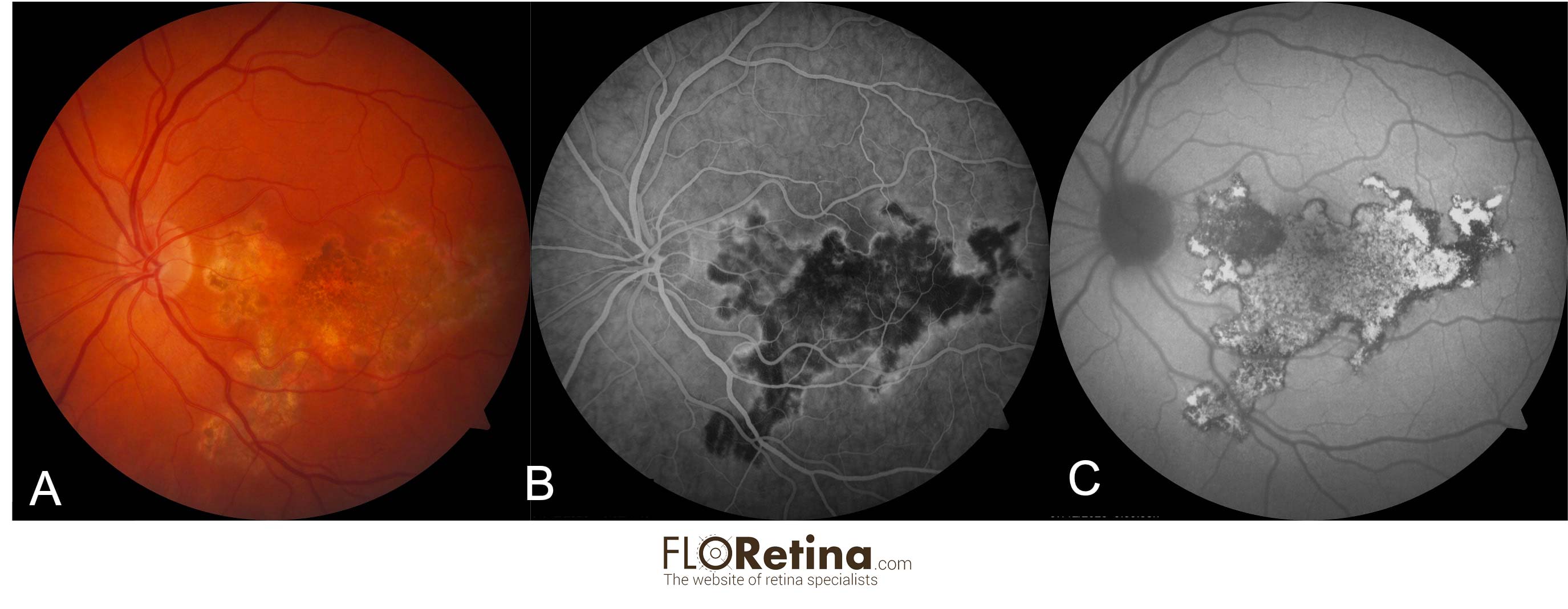 TUBERCULOUS SERPIGINOUS-LIKE CHOROIDITIS 2