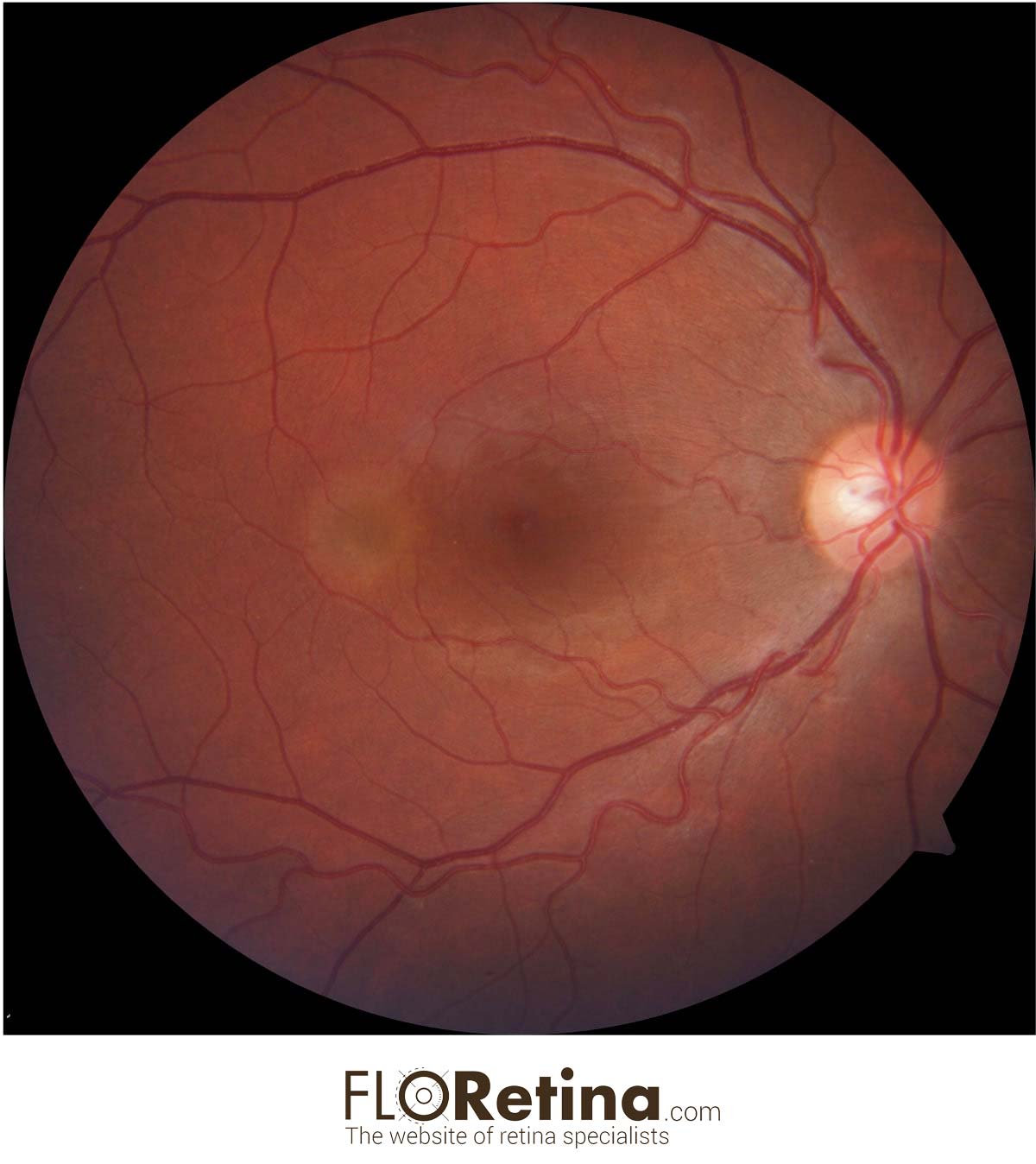 UNILATERAL ACUTE MACULOPATHY CAUSED BY COXSACKIEVIRUS