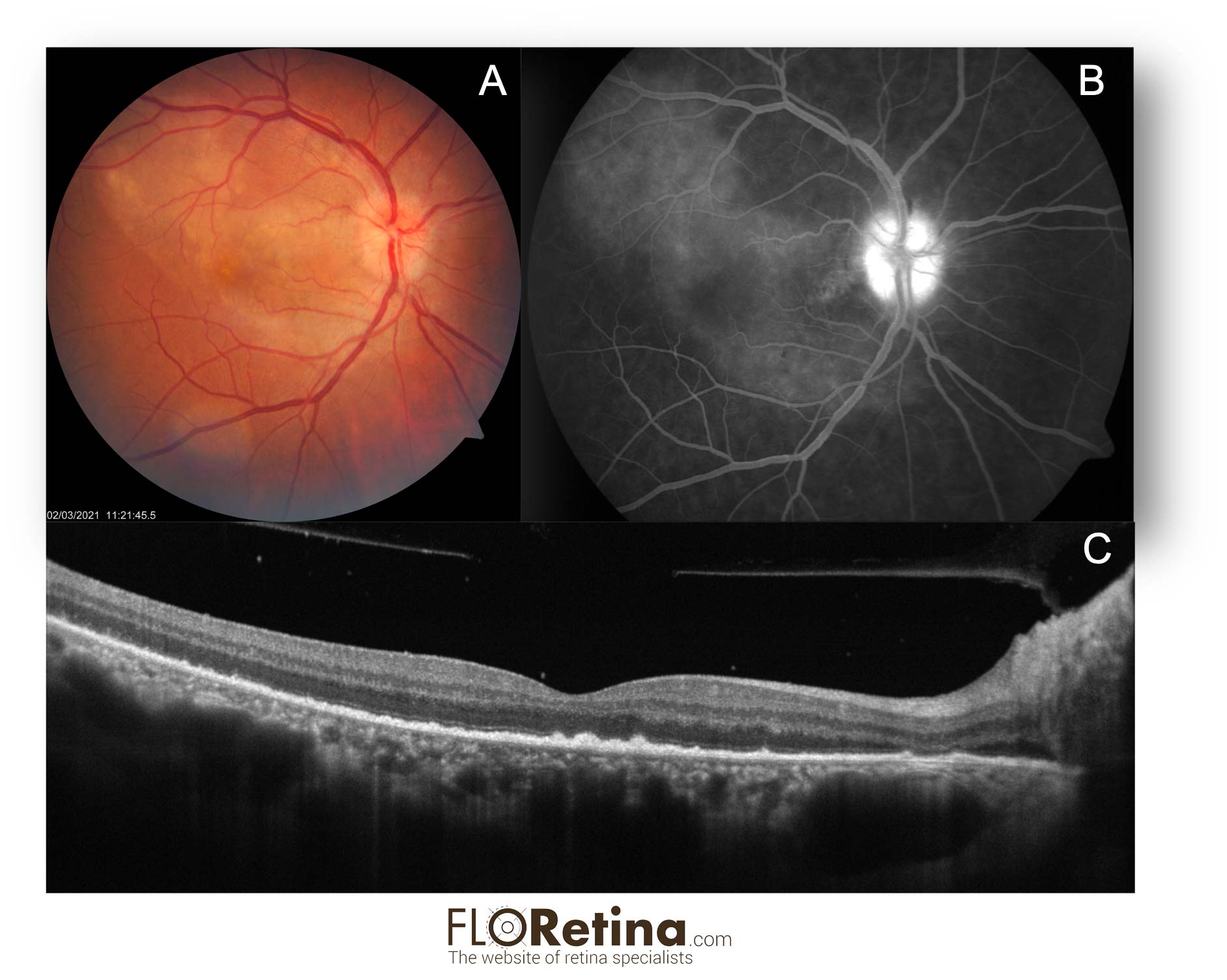 Acute Syphilitic Posterior Placoid Chorioretinopathy (ASPPC)