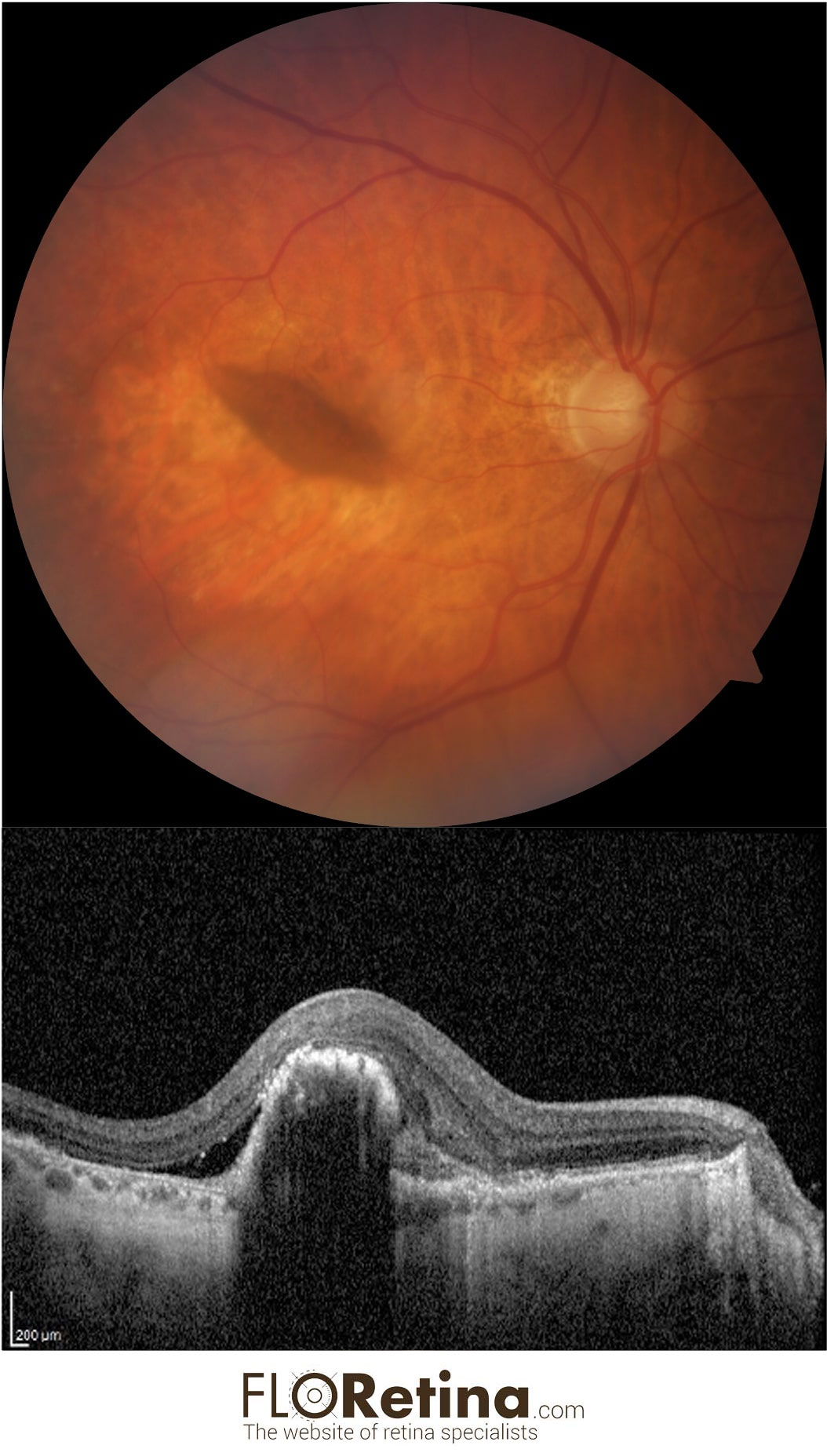 RPE (retinal pigment epithelium) tear