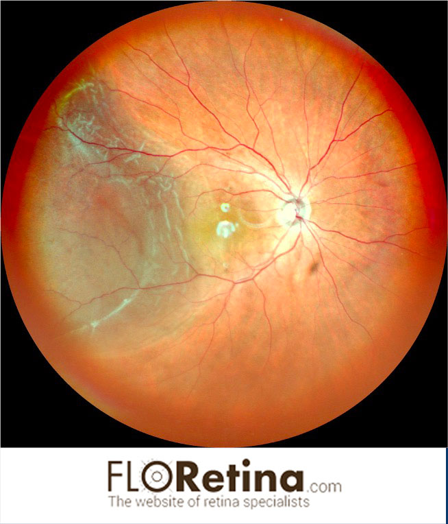 Retinal Detachment