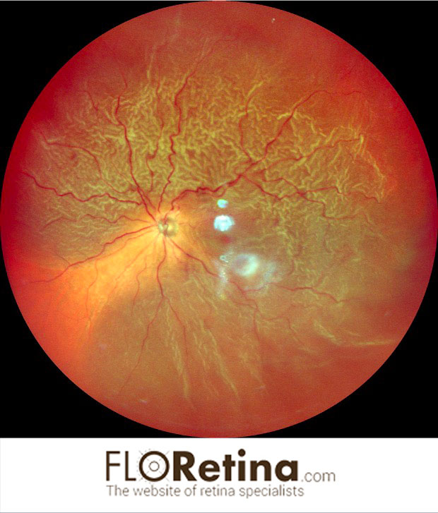 Retinal Detachment 1