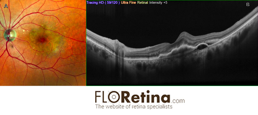 Neovascular AMD