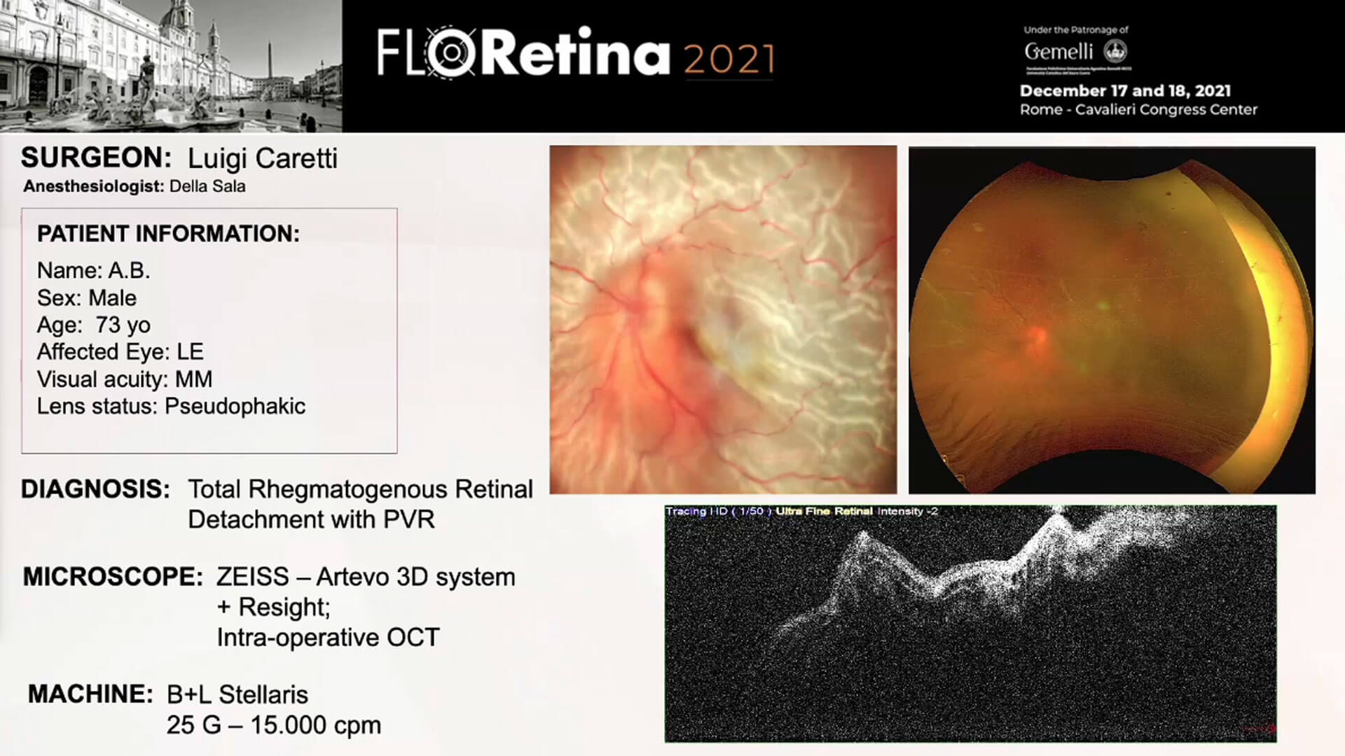 Total rhegmatogenous Retinal Detachment with PVR