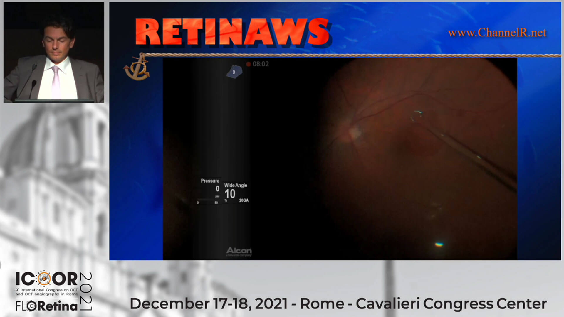 Extra-Large Macular Hole