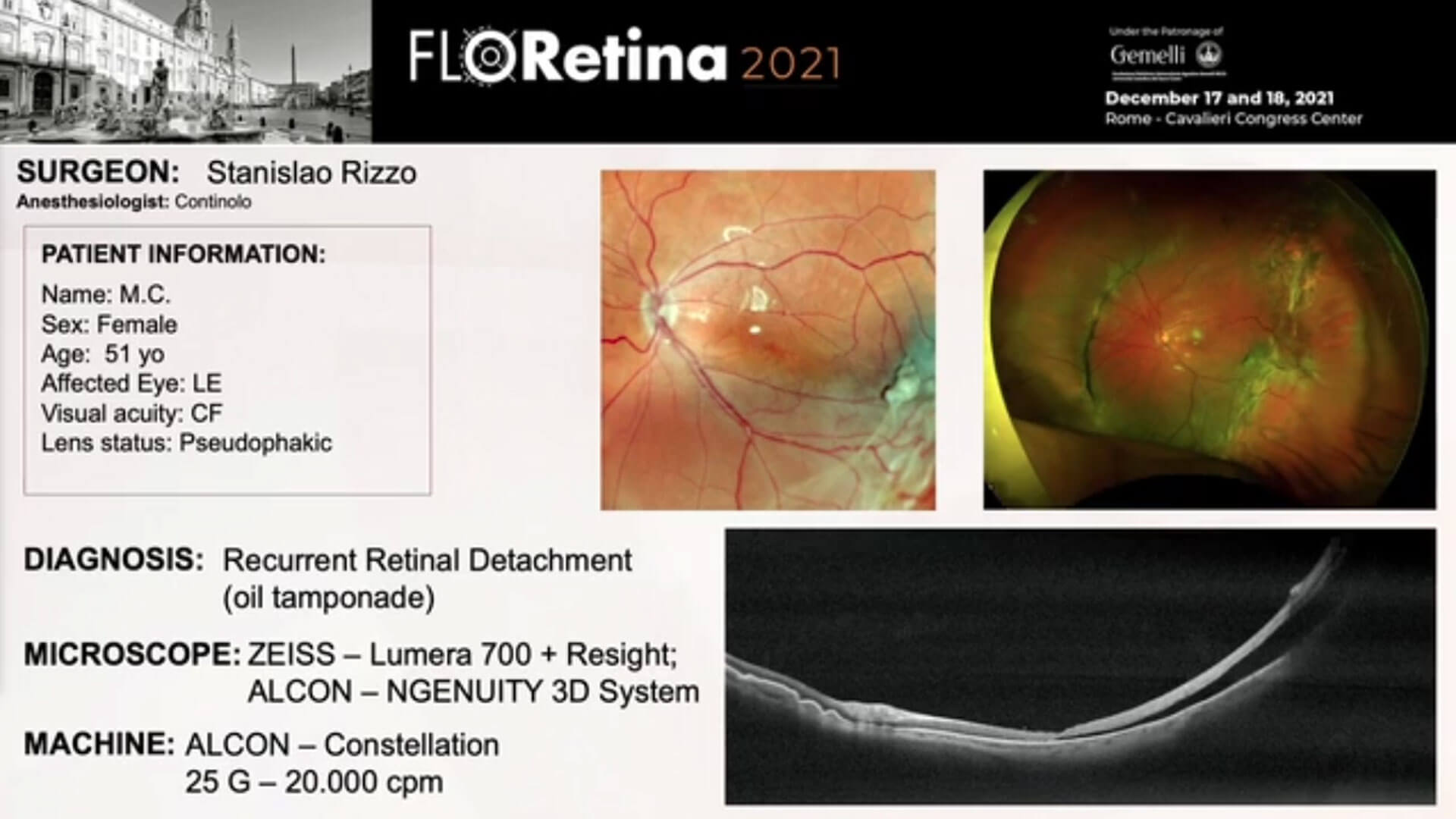 Recurrent Retinal Detachment (oil tamponade)