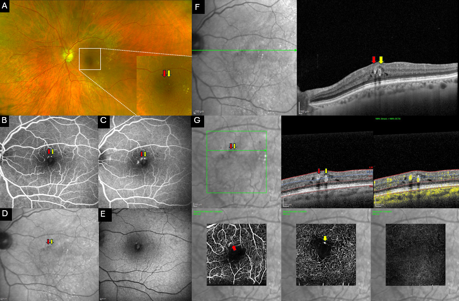 Multimodal imaging of Perifoveal Exudative Vascular Anomalous Complex (PEVAC)