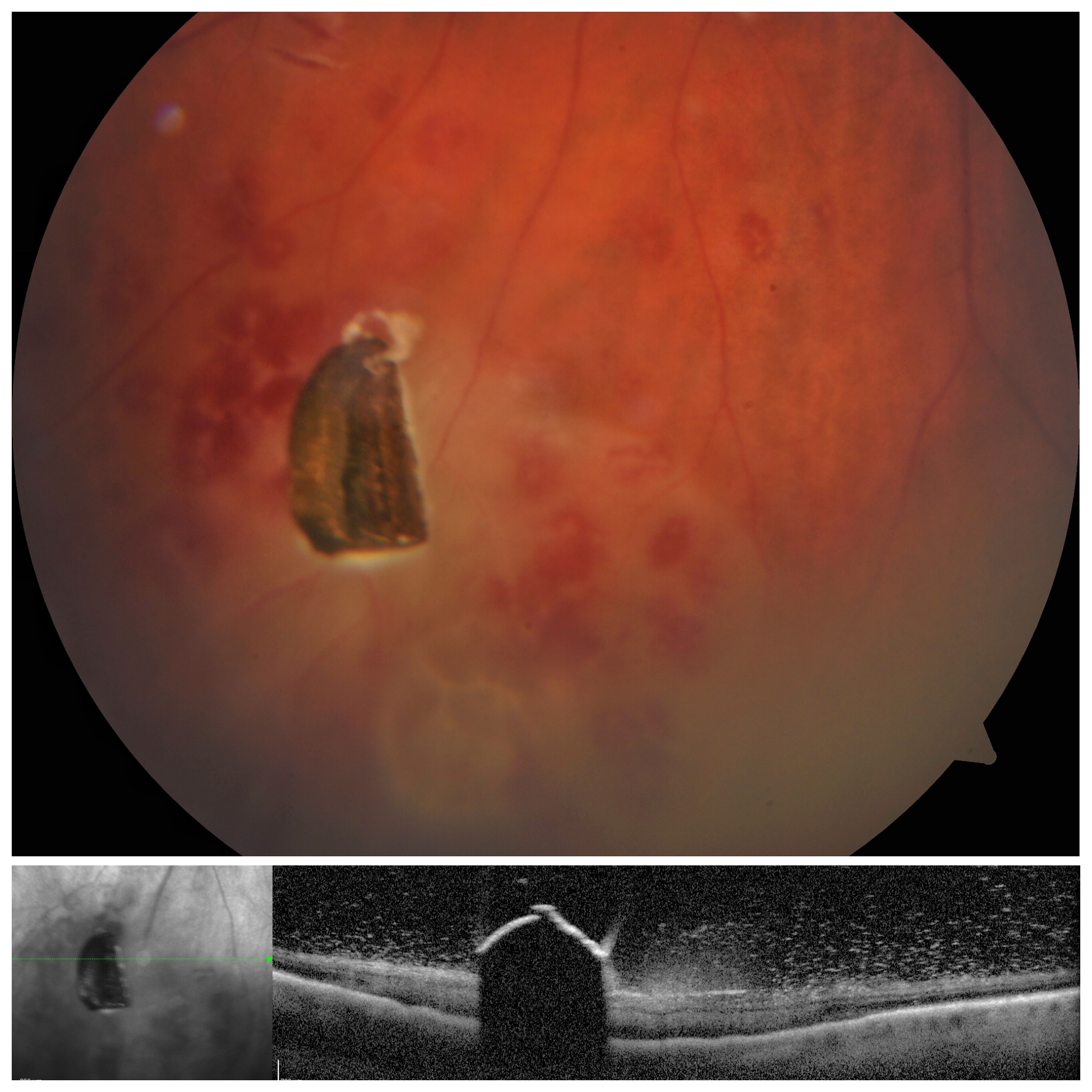 Metallic Intraocular Foreign Body