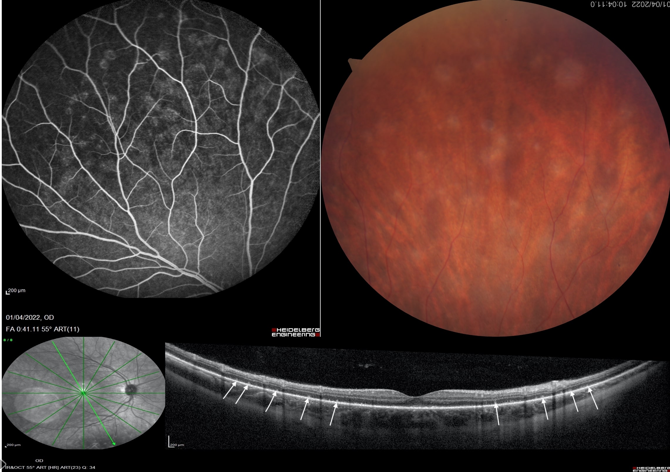 MULTIPLE EVANESCENT WHITE DOT SYNDROME.