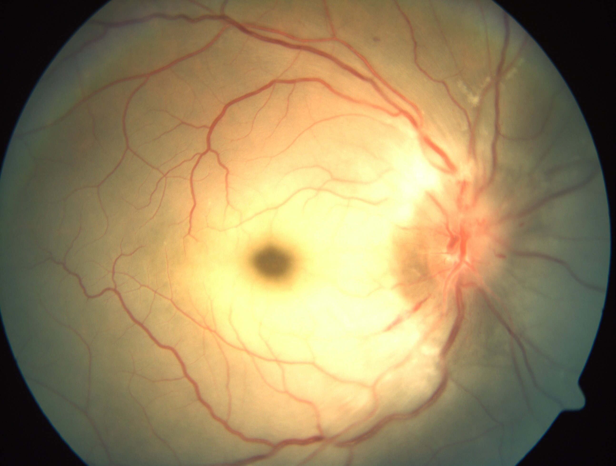 Central retinal artery occlusion