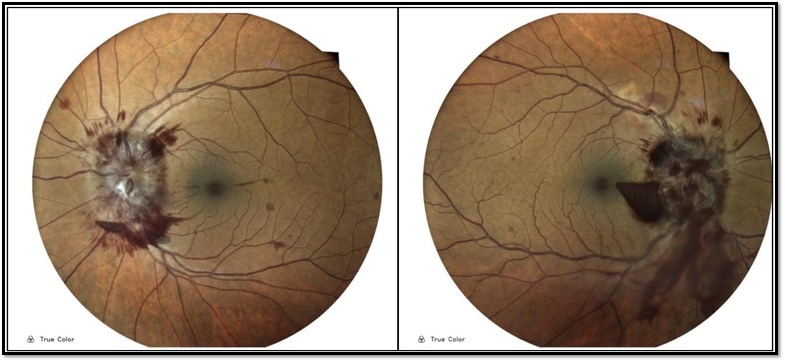 Bilateral papilledema associated with retinal hemorrhagic appearance as earliest sign of spinal cord tumor