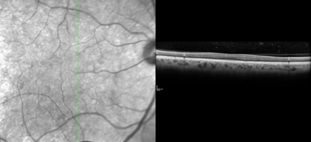Isolated Foveal Hypoplasia