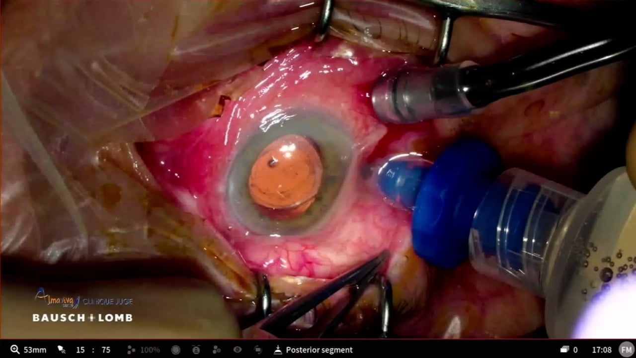 Retinal detachment