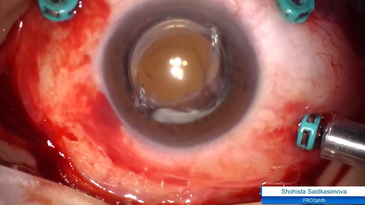 Retinal detachment