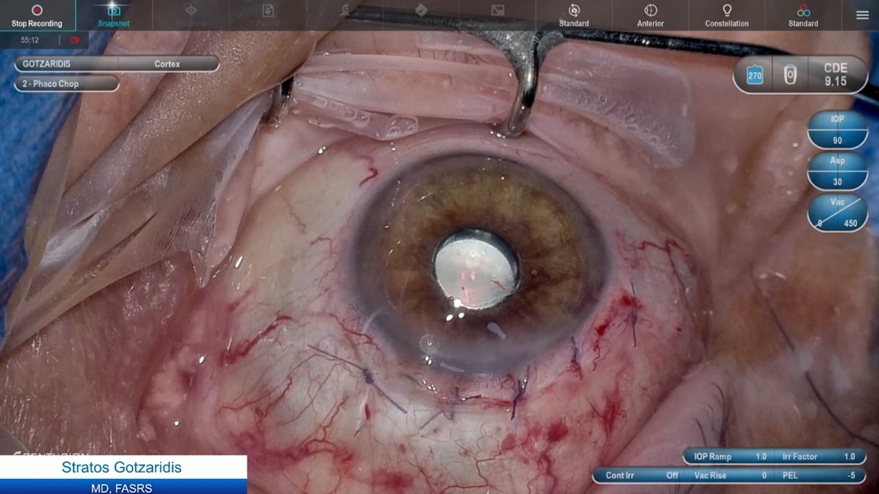 Phakic, dry RE AMD