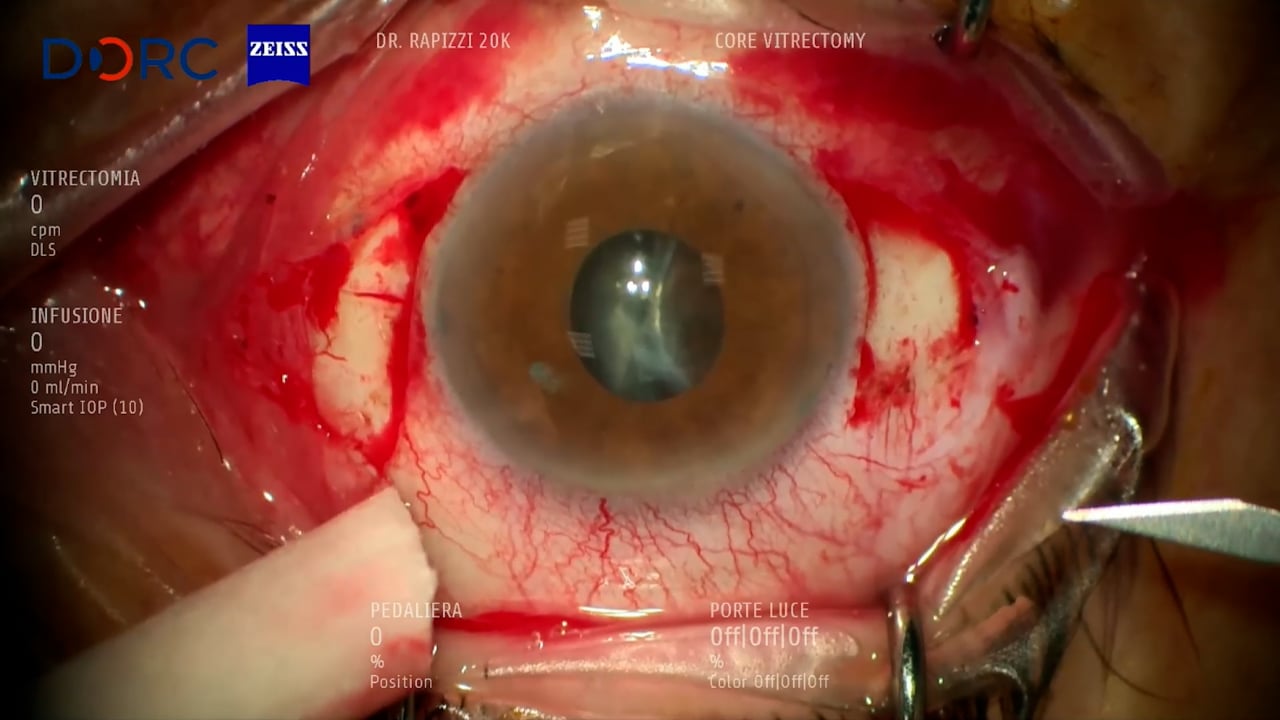 Sub-luxated IOL