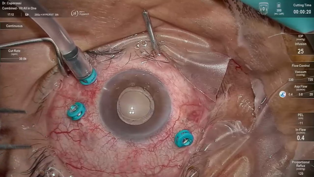 Recurrent retinal detachment under silicone oil