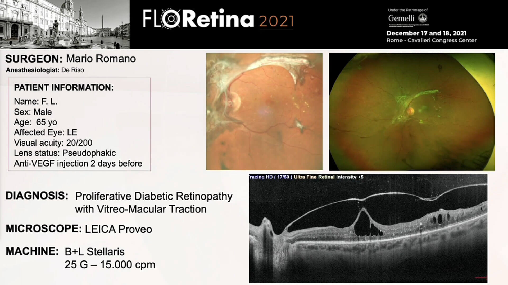 Proliferative Diabetic Retinopathy with Vitreo-Macular Traction