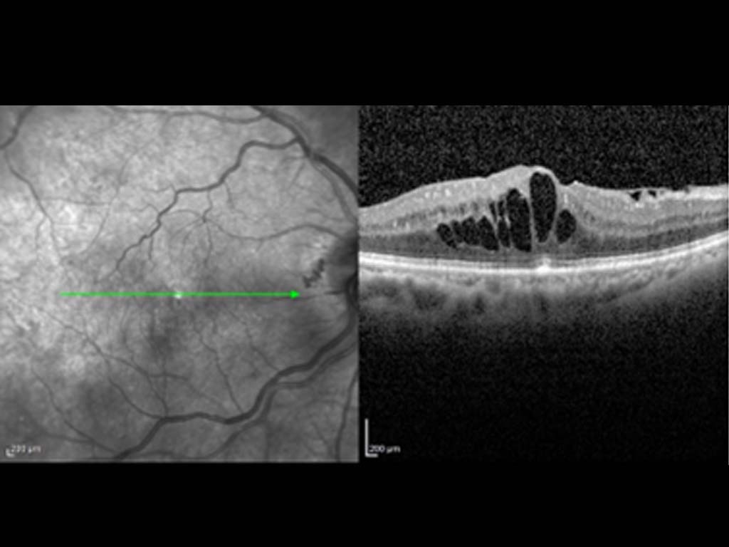 Diabetic macular edema: OCT retinal biomarkers as predictive factors of treatment response and long-term visual outcome