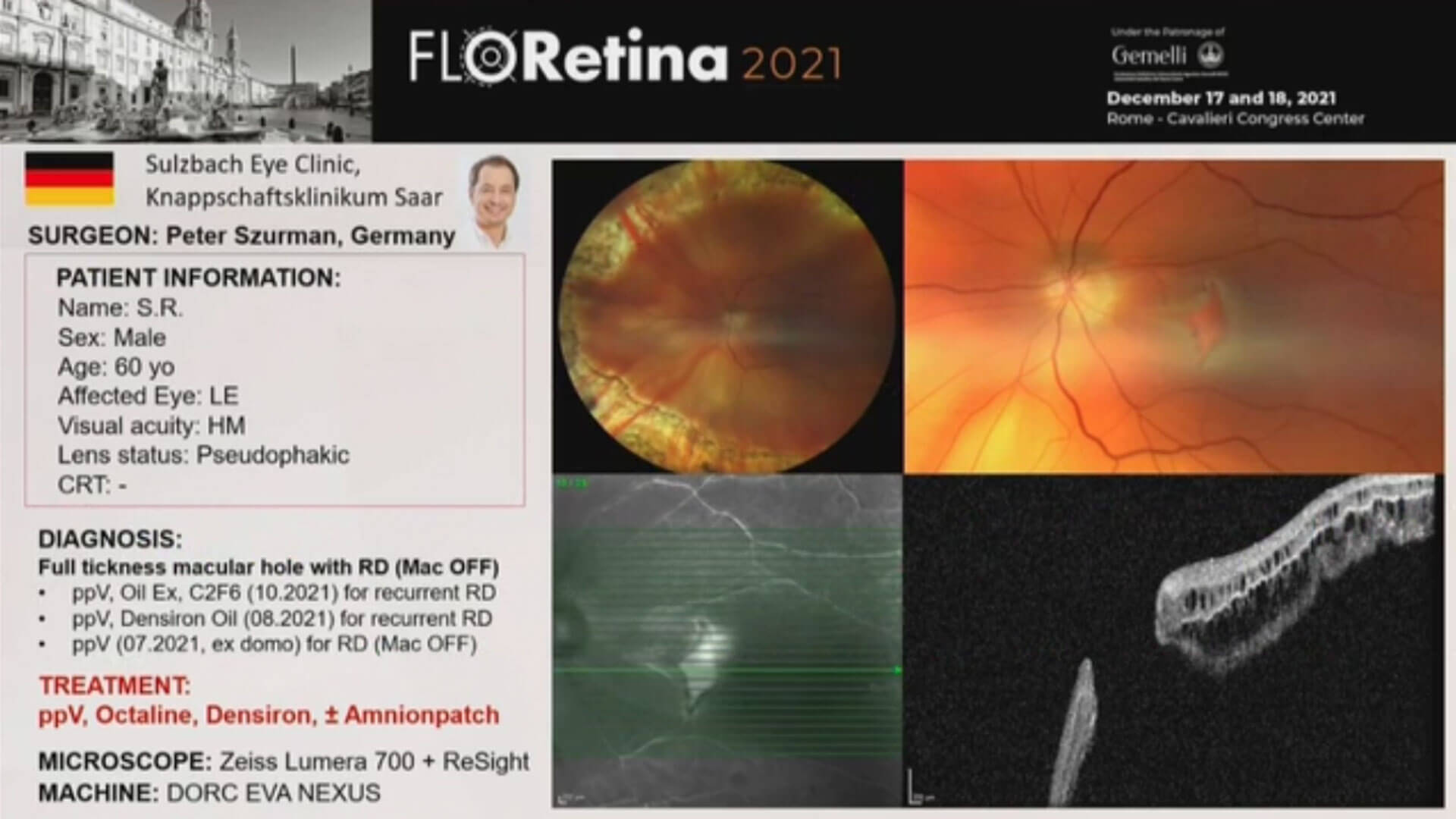 Full tickness macular hole with RD (Mac OFF)