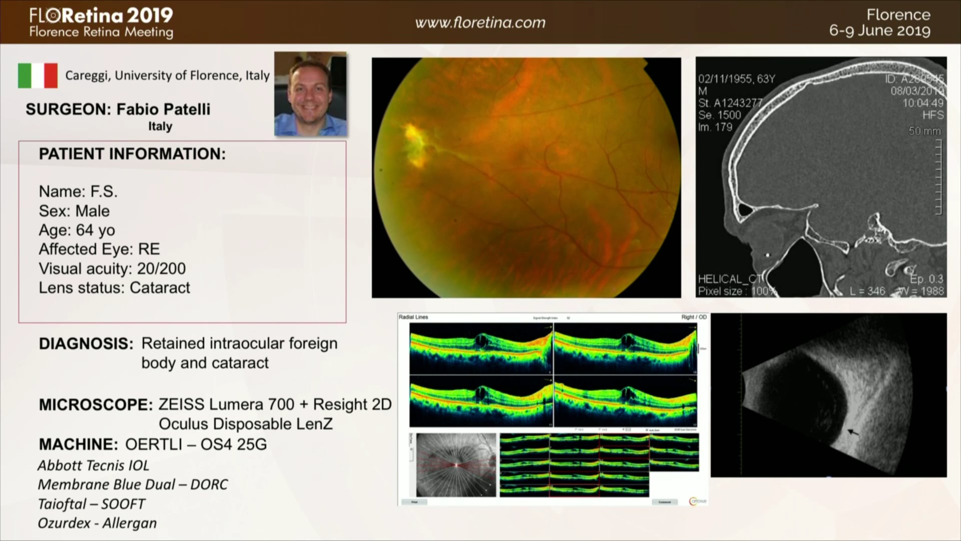 Retained Intraocular Foreign Body and Cataract