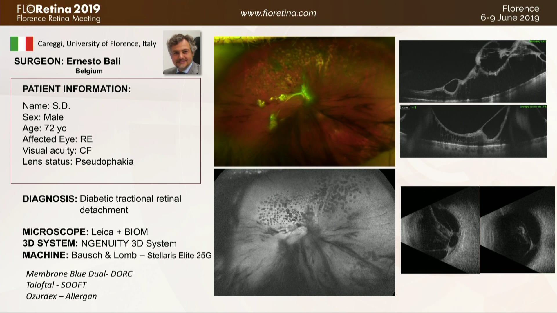 Diabetic Tractional Retinal Detachment