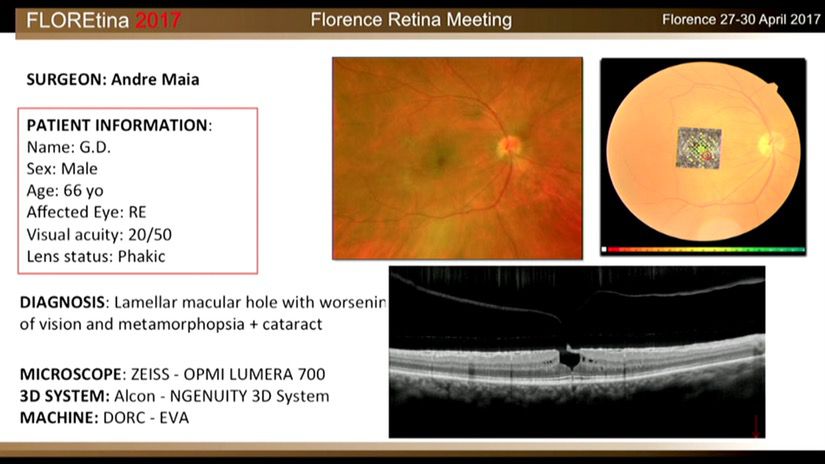 Lamellar Macular Hole And Metamorphosia + Cataract