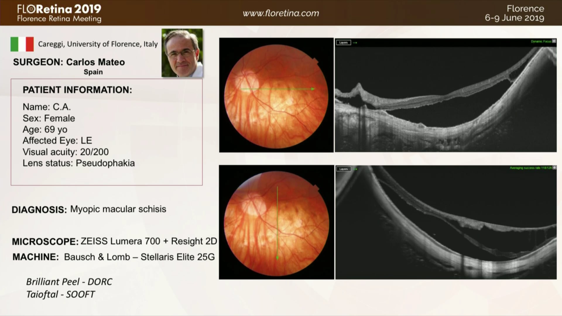 Myopic Macular Schisis and Cataract
