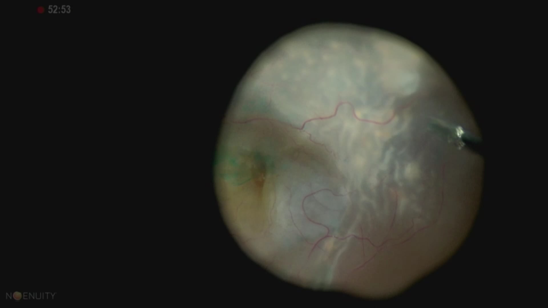 Macular Hole Retinal Detachment - PVR