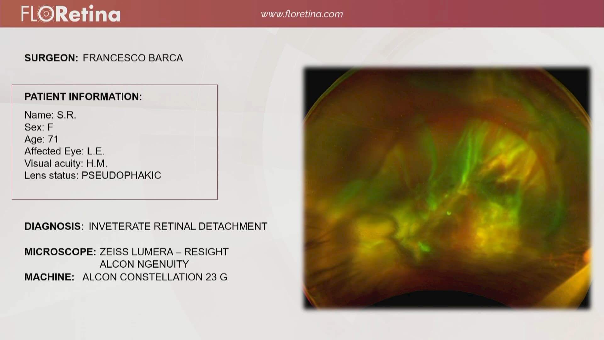 Inveterate Retinal Detachment