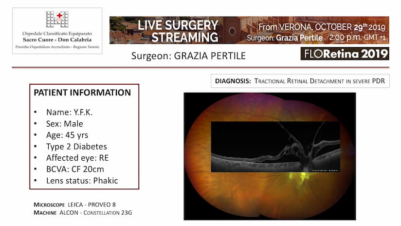Diabetic Tractional Retinal Detachment
