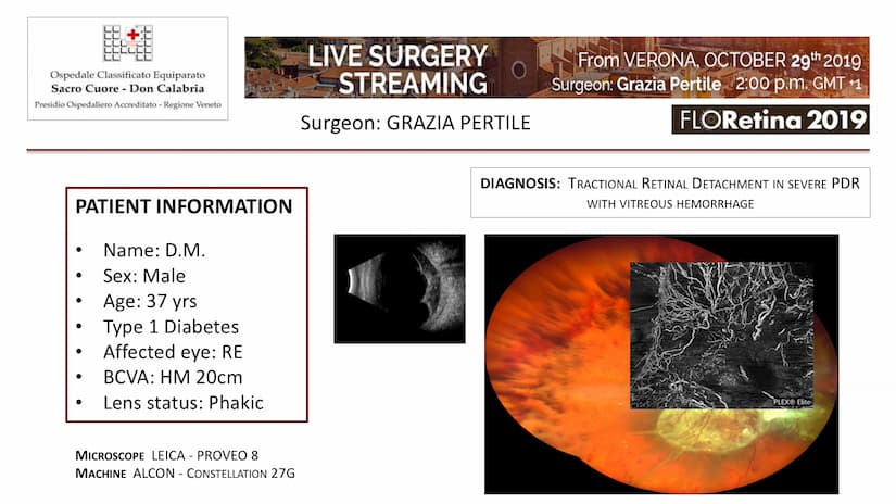 Tractional Retinal Detachmente In Severe PDR With Vitreous Hemorrhage