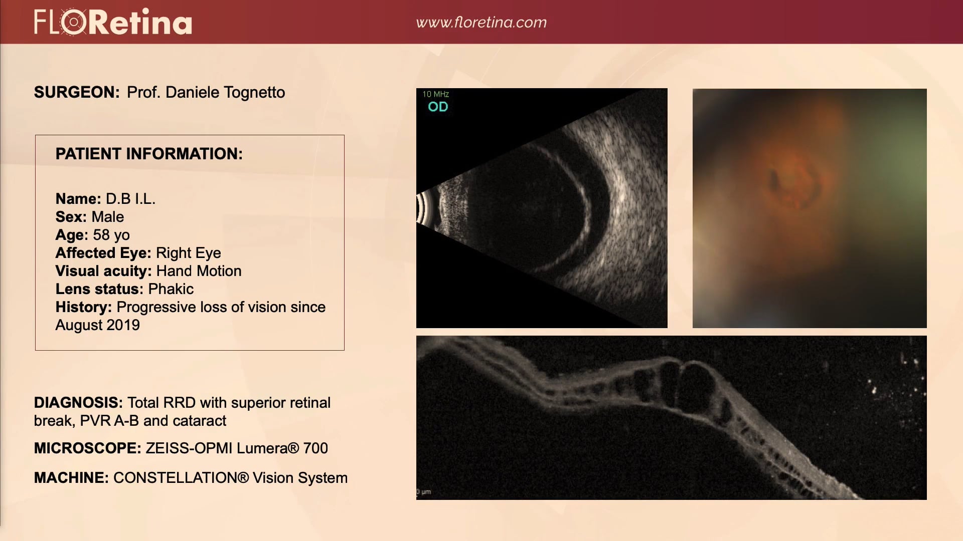 Total RRD With Superior Retinal Break, PVR-A And Cataract