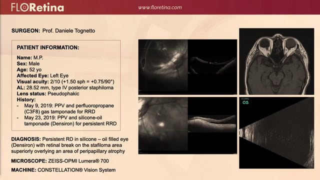 Persistent RD In Silicone - Oil Filled Eye (Densiron) With Retinal Break On Stafiloma Area