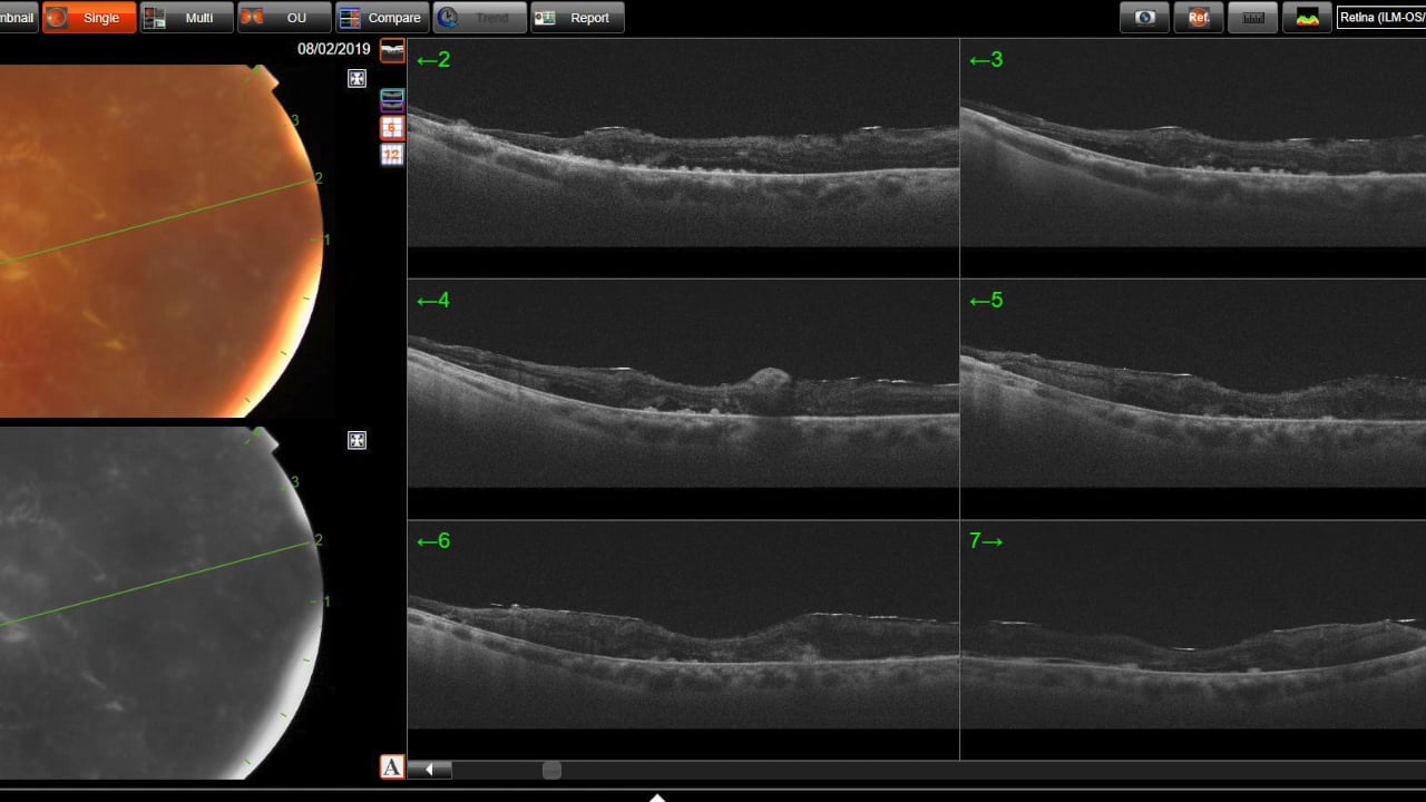 DIABETIC RETINOPATHY