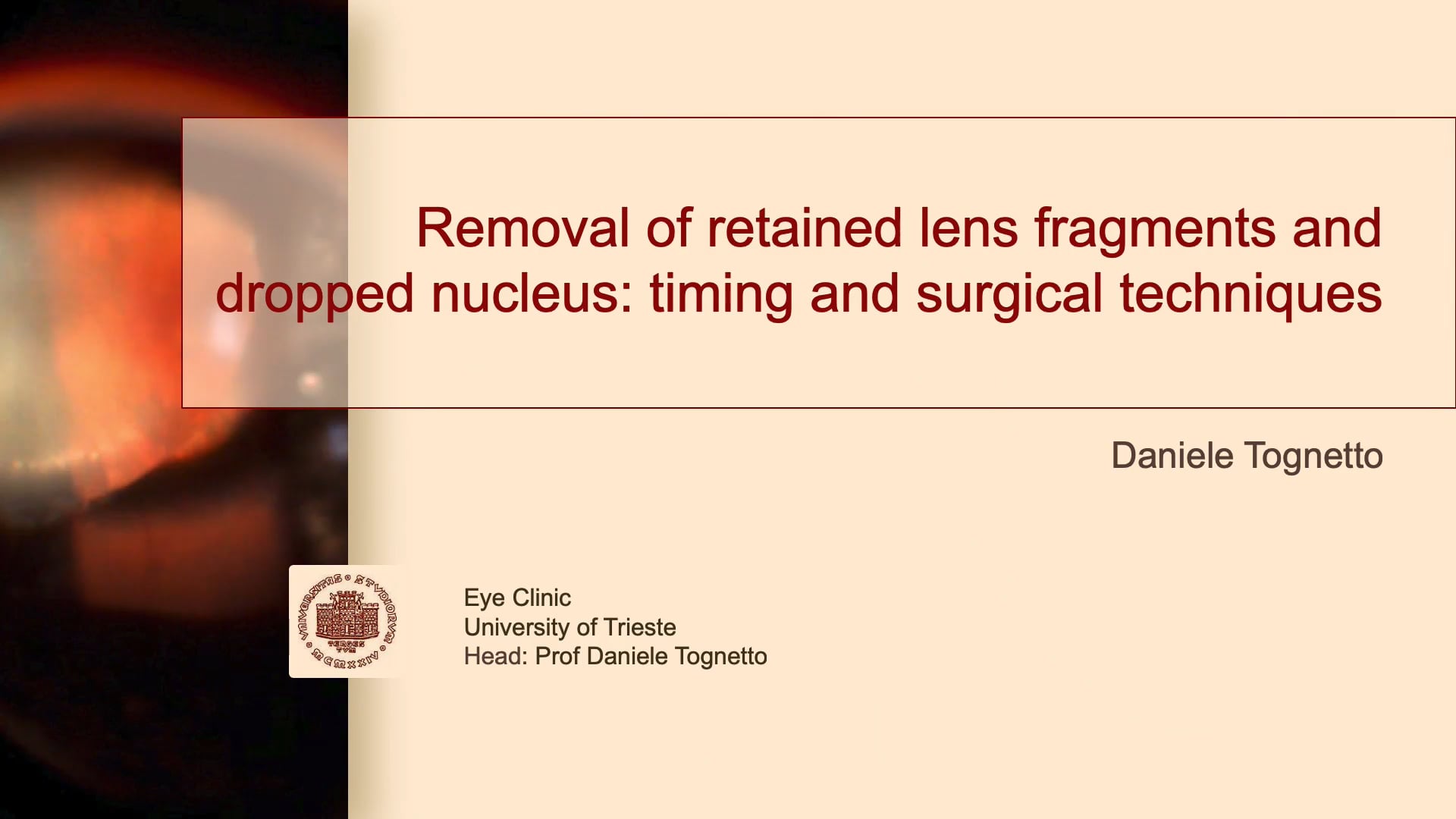 Removal Of Retained Lens Fragments And Dropped Nucleus: Timing And Surgical Techniques