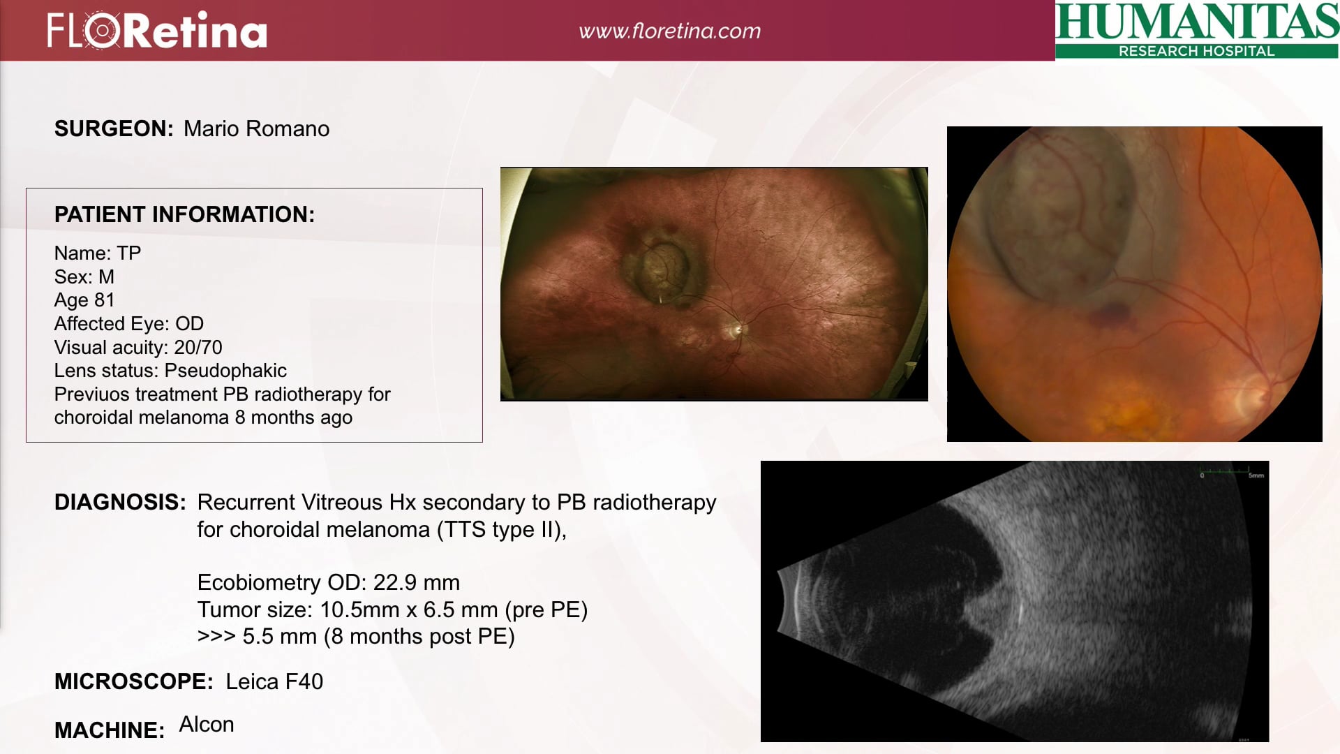 Recurrent Vitreous Hx Secondary To PB Radiotherapy For Choroidal Melanoma