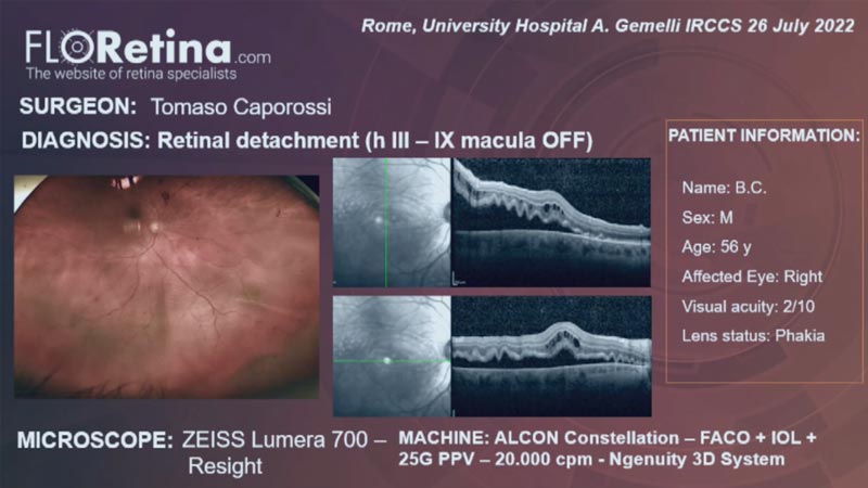 RETINAL DETACHMENT (h III – macula OFF)  (Rome, 26/07/2022)