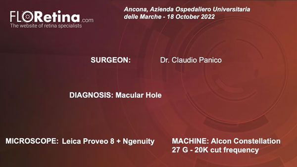 MACULAR HOLE (Ancona, 18/10/22)