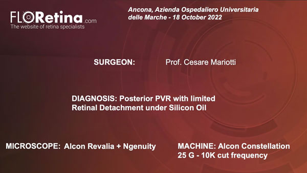 POSTERIOR PVR WITH LIMITED RETINAL DETACHMENT UNDER SILICON OIL (Ancona, 18/10/22)