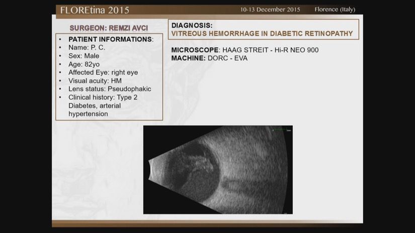 Vitreous Hemorrhage In Diabetic Retinopathy