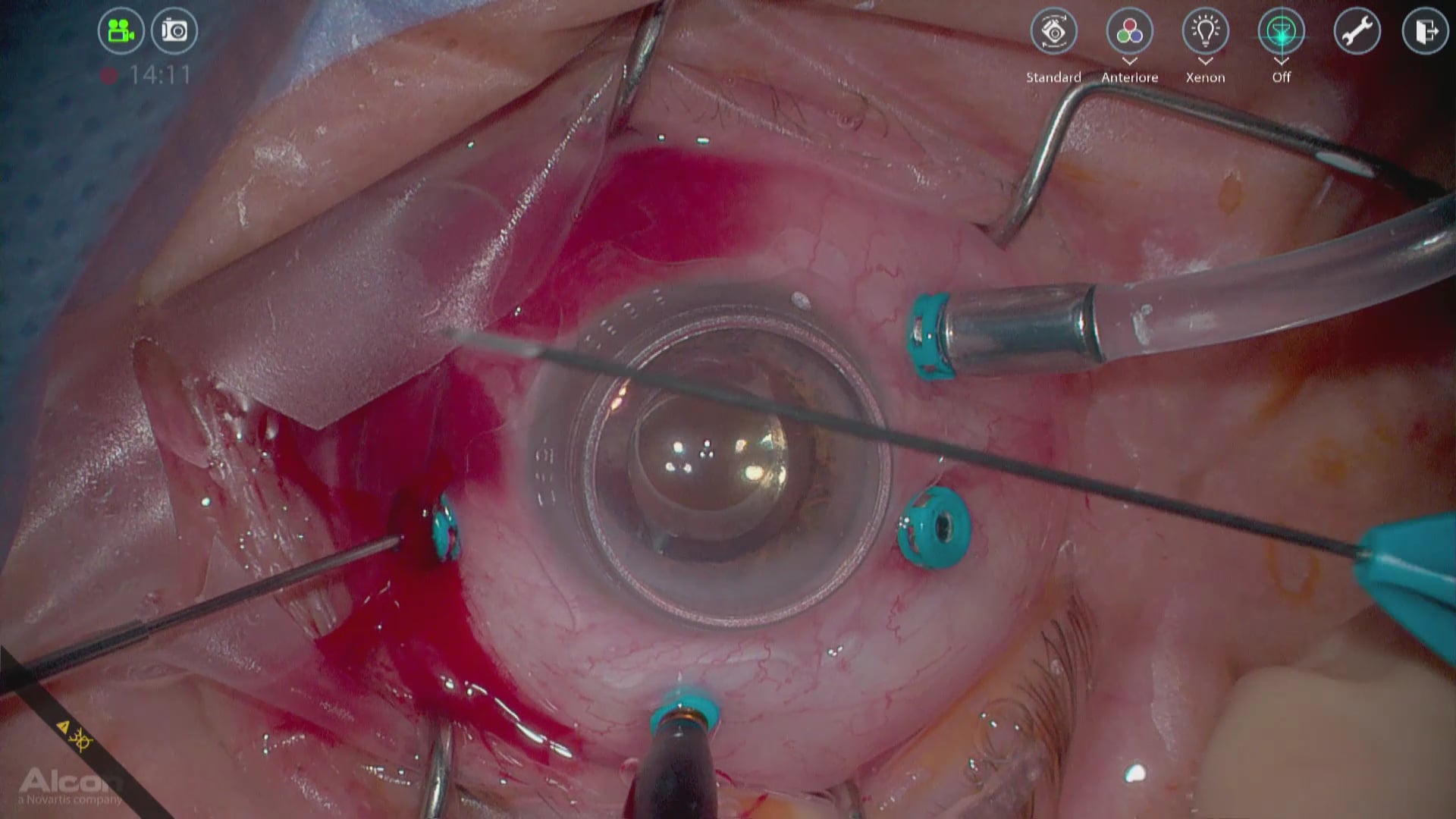Macular Hole