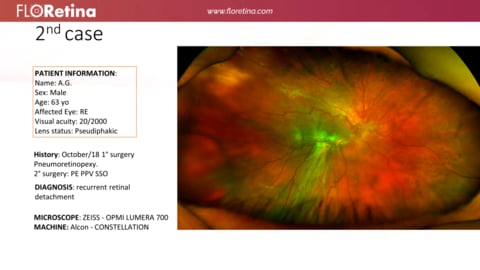 Retinal Detachment