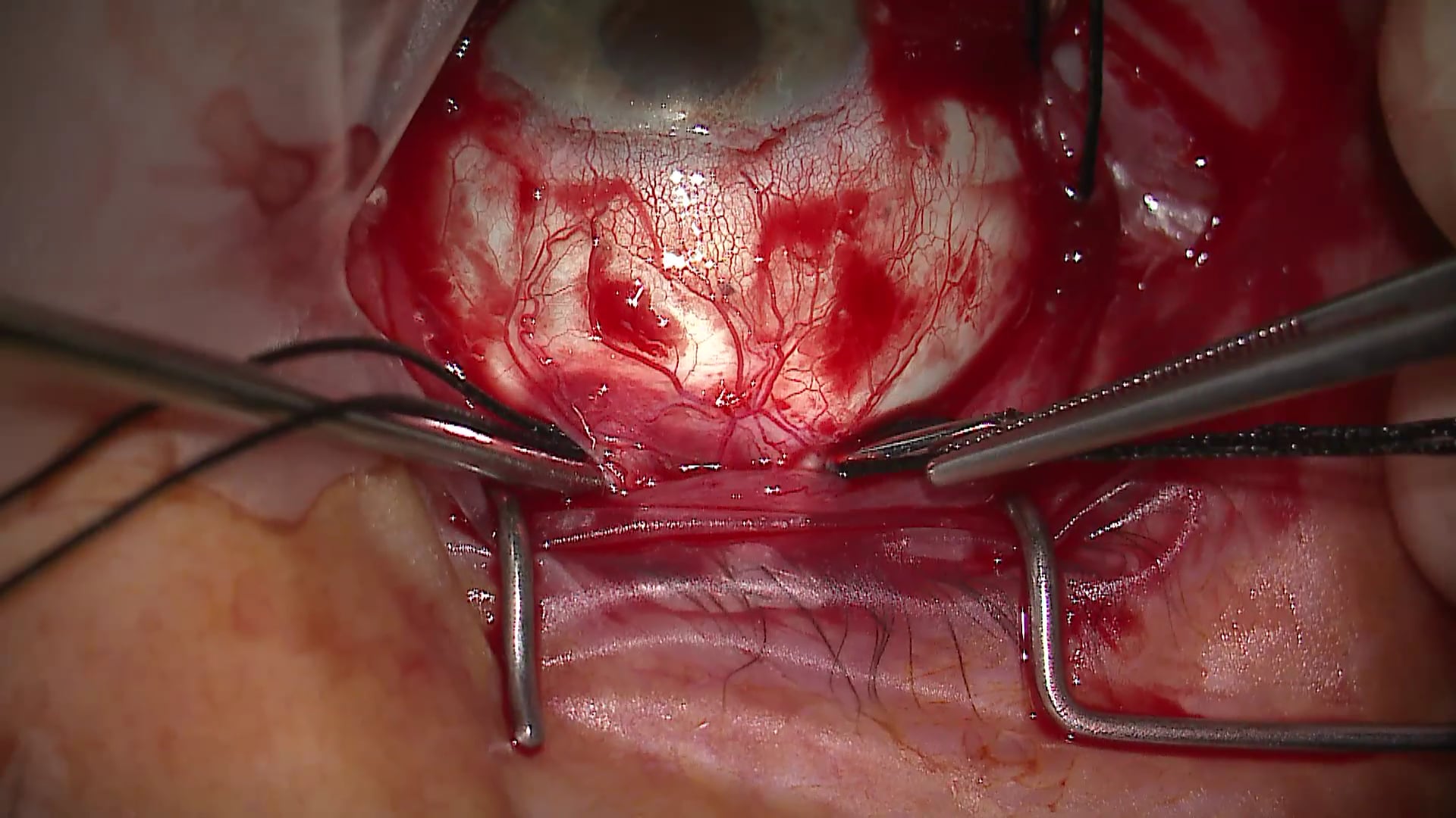 Retinal Detachment