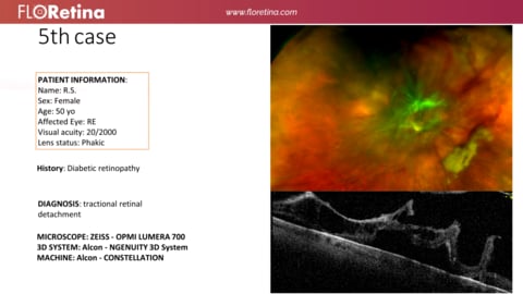 DIABETIC RETINOPATHY