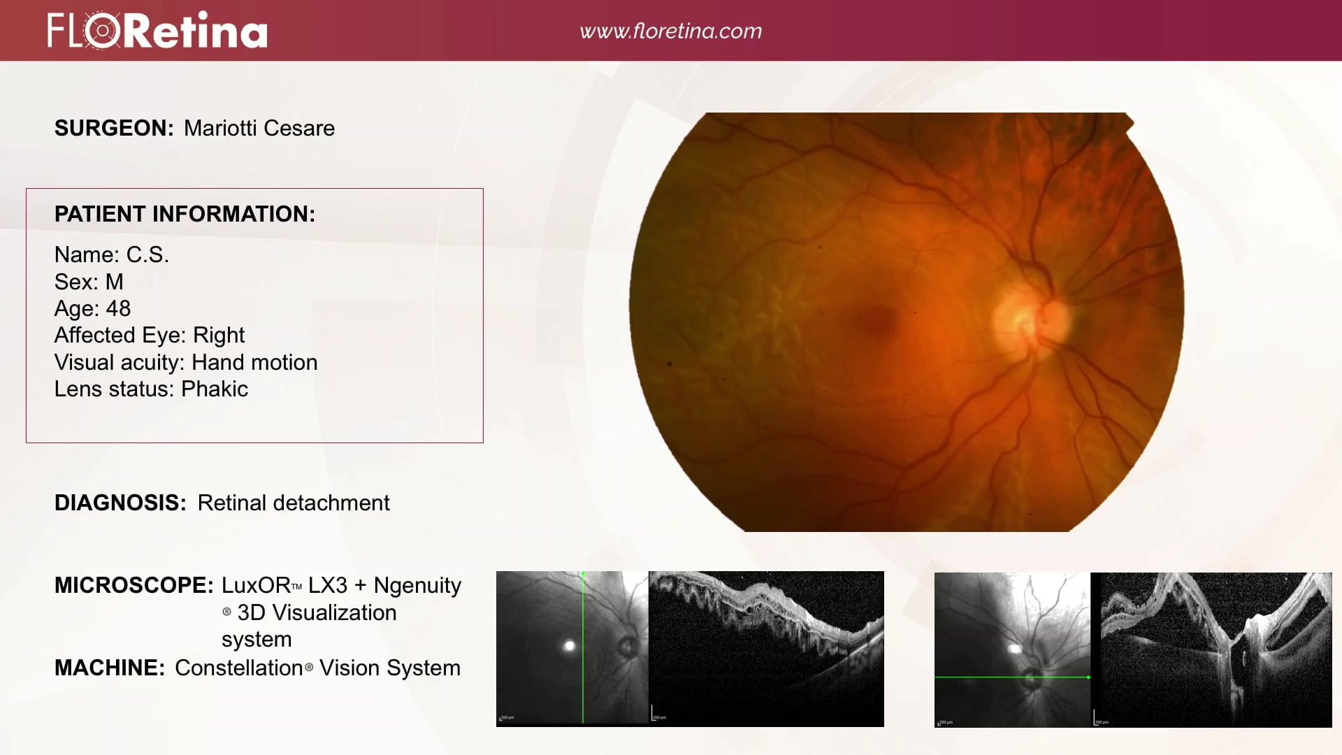 Retinal Detachment