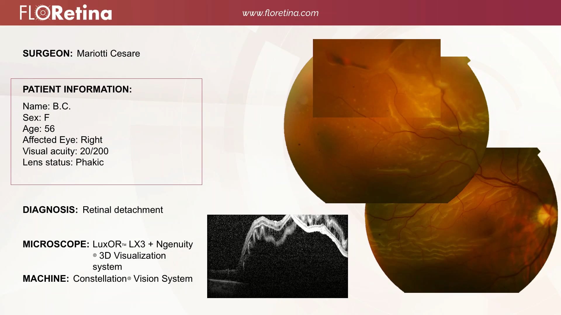 Retinal Detachment