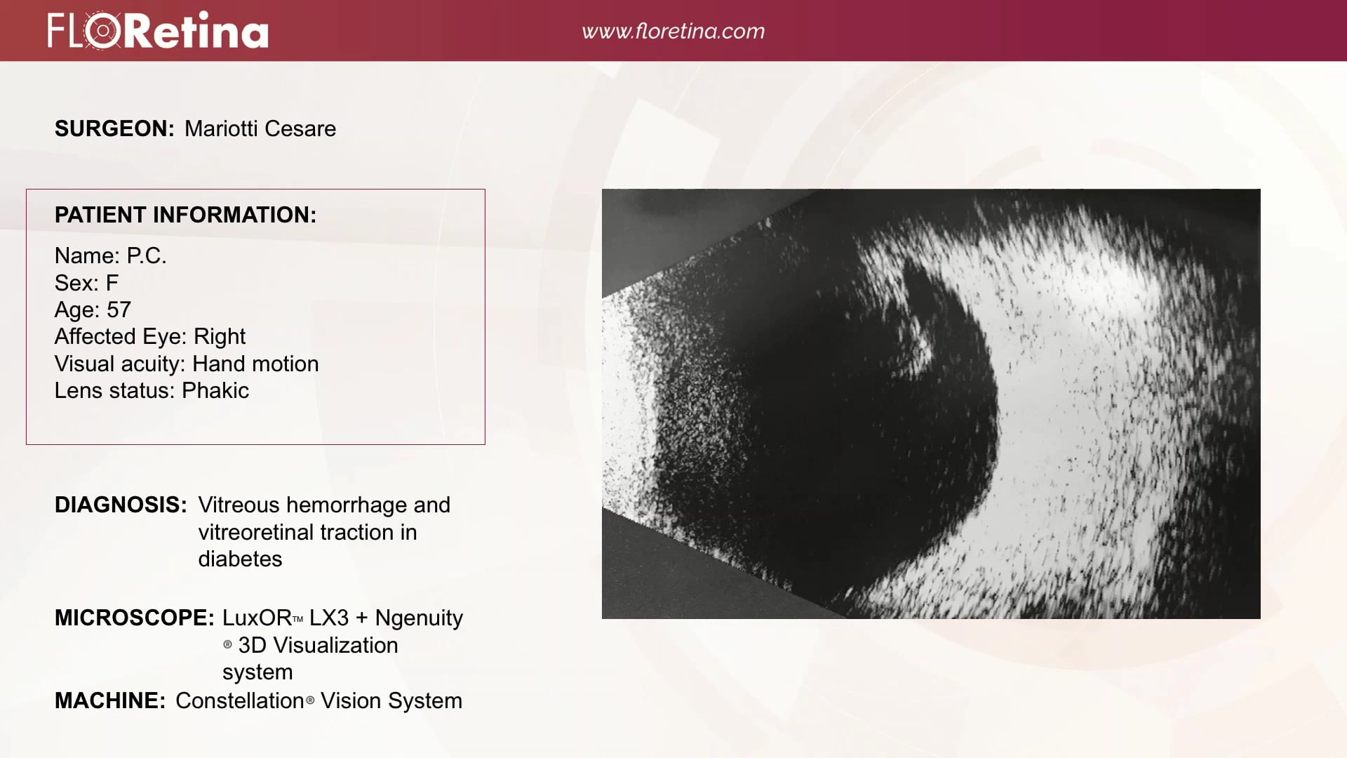 Vitreous Hemorrhage And Vitreoretinal Traction In Diabetes