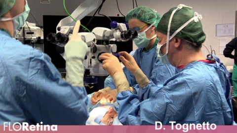 Rhegmatogenous Retina Detachment + PVR D3