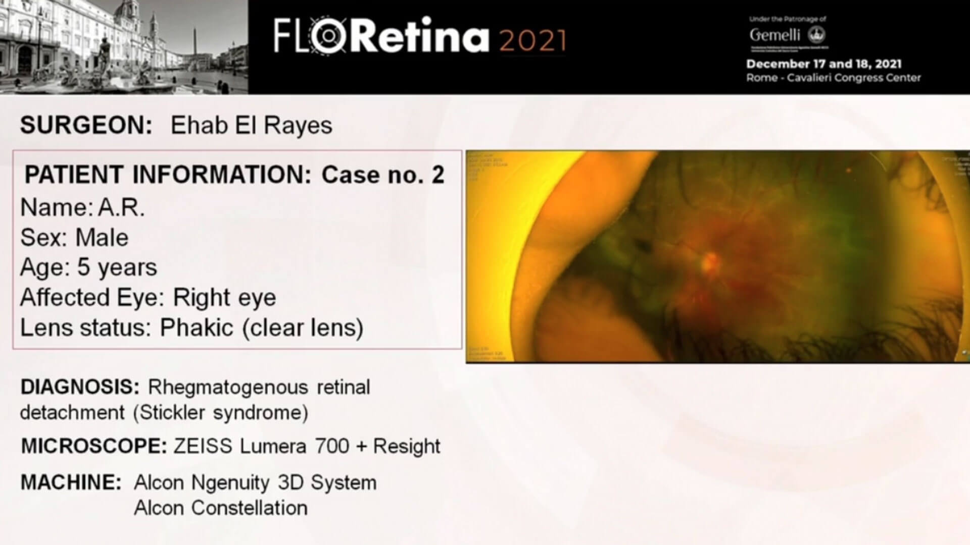 Rhegmatogenous Retinal Detachment (Stickler syndrome)